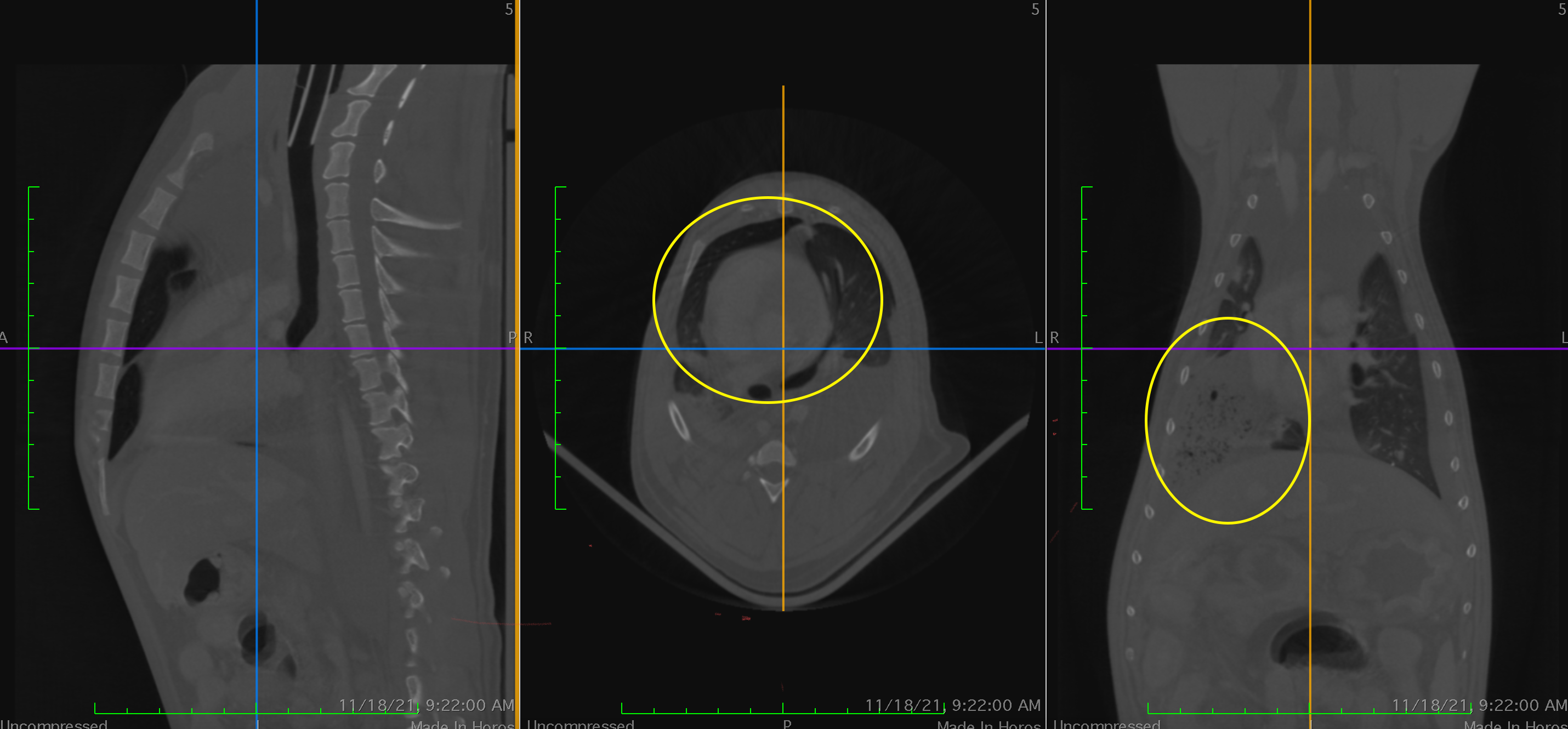 A consolidated lung lobe