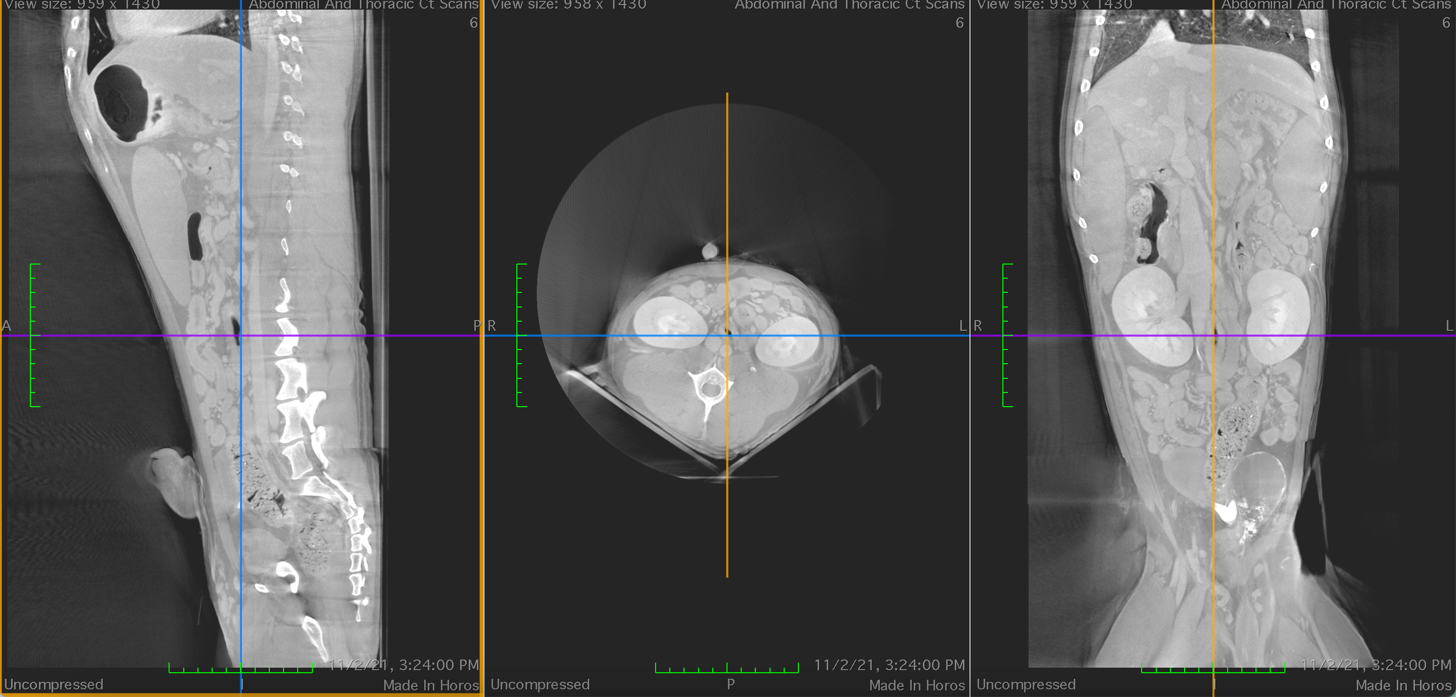 Post contrast of a normal abdomen