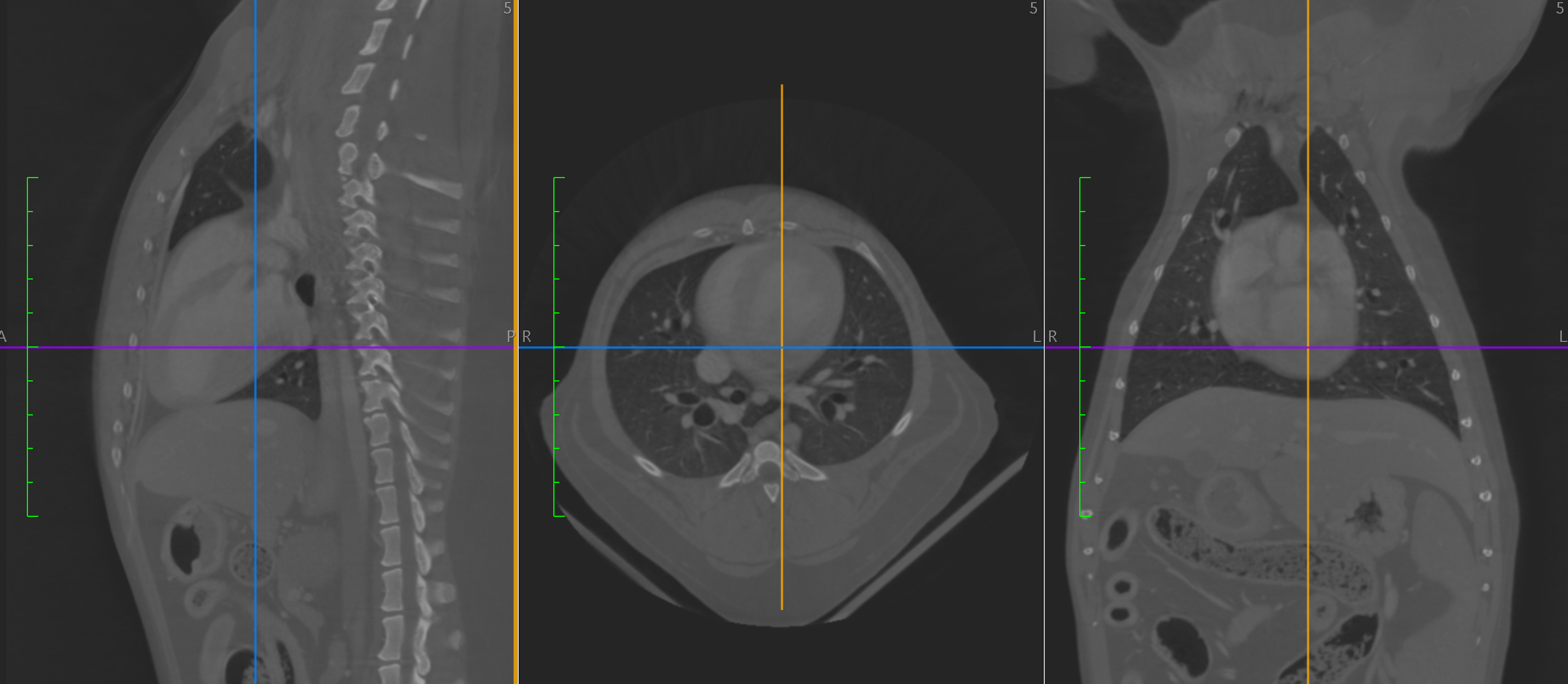 Post contrast of a normal chest